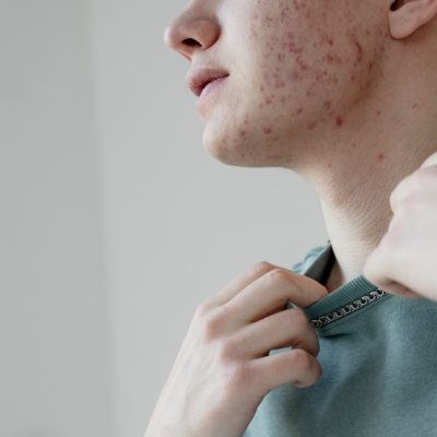 Acne