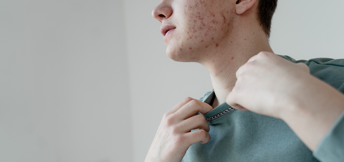Acne