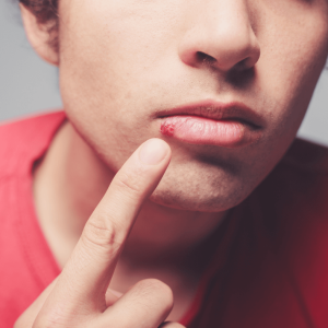 Cold-Sore-Treatment-2