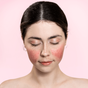 rosacea-treatment-mobile